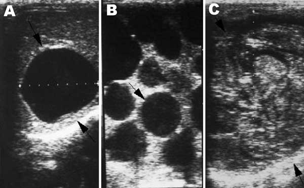 Lesions of cystic echinococcosis (CE) by abdominal ultrasound examination. A) CE lesion with distinct rim. B) Typical CE lesion with daughter cysts. C) Calcified CE lesion after chemotherapy.