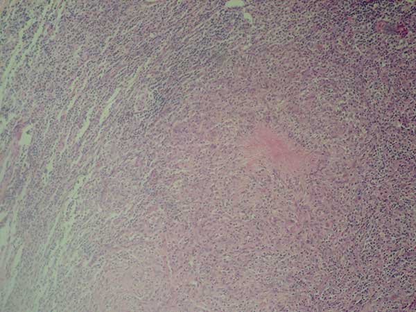Digitally processed hematoxylin-eosin staining of the excised lymph nodes, showing caseating, tuberculosislike granulomas (original magnification ×100).