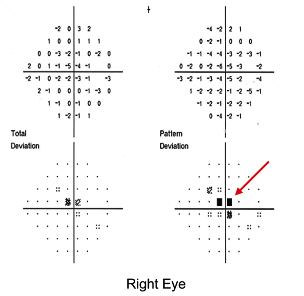 Humphrey visual fields of patient 9 at 1 week after onset of visual symptoms. Central scotoma of the right visual field is denoted as black squares (red arrow).