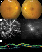 Thumbnail of Fundal photos, fundal fluorescein angiography and optical coherence tomography (OCT) of patient 9. A) areas of blot hemorrhages temporal to the right fovea. B) bilateral dye leakage from the retinal veins, more severe on the right than left. C) OCT gives a 2-dimensional graphic representation of a cross-section of the macular region. The area marked with the red arrow marks the site of exudative retinal detachment. Both sides have marked retinal thickening (edema). Photo: Ken Thian.