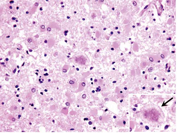 Histopathologic changes in frontal cerebral cortex of the patient who died of variant Creutzfeldt-Jakob disease in the United States. Marked astroglial reaction is shown, occasionally with relatively large florid plaques surrounded by vacuoles (arrow in inset) (hematoxylin and eosin stain, original magnification ×40).