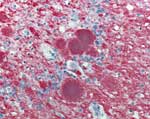 Thumbnail of Immunohistochemical staining of cerebellar tissue of the patient who died of variant Creutzfeldt-Jakob disease in the United States. Stained amyloid plaques are shown with surrounding deposits of abnormal prion protein (immunoalkaline phosphatase stain, naphthol fast red substrate with light hematoxylin counterstain; original magnification ×158).