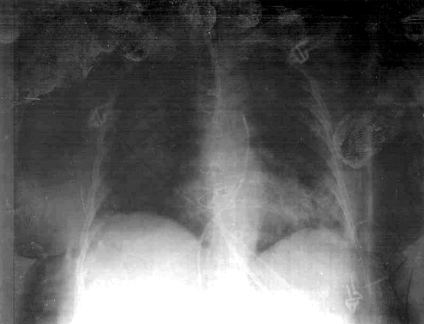 Chest radiograph of the patient showing bilateral alveolar infiltrates. Although pulmonary edema was the initial diagnosis, an infectious cause should be considered and, on the basis of sepsis, appropriate treatment initiated.