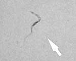 Thumbnail of Trypomastigote (arrow) in a Giemsa-stained cerebrospinal fluid smear of patient 1 (original magnification ×1,000).