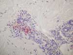 Thumbnail of Immunohistochemical results showing rickettsiae in inflammatory infiltrates of the dermis (polyclonal rabbit anti-Rickettsia sp. antibody using a dilution of 1:1,000 and hematoxylin counterstain; original magnification ×250).