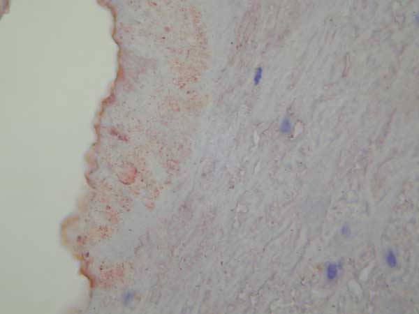 Immunohistochemical demonstration of Bartonella sp. in a cardiac valve of a patient with endocarditis. Magnification ×400.