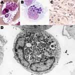 Thumbnail of Anaplasma phagocytophilum in human peripheral blood band neutrophil (A. Wright stain, original magnification ×1,000), in THP-1 myelomonocytic cell culture (B, LeukoStat stain, original magnification, ×400), in neutrophils infiltrating human spleen (C, immunohistochemistry with hematoxylin counterstain; original magnification ×100), and ultrastructure by transmission electron microscopy in HL-60 cell culture (D; courtesy of V. Popov; original magnification ×21,960).