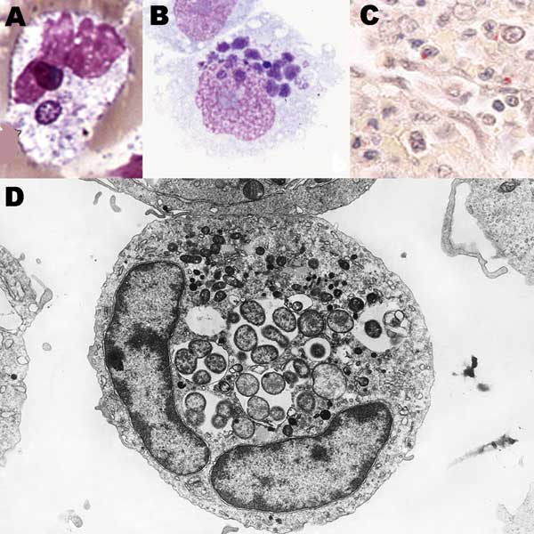 Anaplasma phagocytophilum in human peripheral blood band neutrophil (A. Wright stain, original magnification ×1,000), in THP-1 myelomonocytic cell culture (B, LeukoStat stain, original magnification, ×400), in neutrophils infiltrating human spleen (C, immunohistochemistry with hematoxylin counterstain; original magnification ×100), and ultrastructure by transmission electron microscopy in HL-60 cell culture (D; courtesy of V. Popov; original magnification ×21,960).