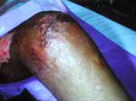 Thumbnail of Surgically debrided lesions.