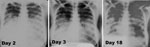Thumbnail of Three serial frontal chest radiographs from surviving caregiver B2 with primary pneumonic plague obtained on illness days 2, 3, and 18 showing bilateral lower lung zone predominant airspace disease associated with bilateral (right &gt; left) pleural effusions. The radiographs have artifacts related to hand-dipping of the films, which account for multiple densities that move between images and the areas of apparent lucency.