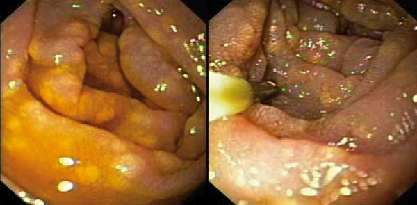 Yellow plaques in the mucosa of the duodenum in patient 2. Similar lesions had been observed in patient 1 in the colon, ileum, and bladder, whereas white lesion had been described in the other AIDS patient with gastrointestinal disease (9).