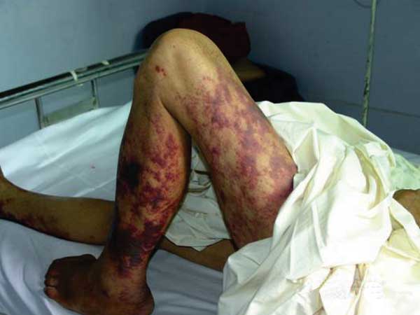 Figure 4. Photograph of a Streptococcus suis patient's legs with streptococcal toxic shock syndrome, featuring purpura and evidence of gangrenous changes in the calf extending down to the foot.