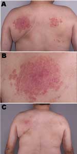 Thumbnail of A) Appearance of rash on the patient's back at initial treatment. B) Close-up of the rash shown in panel A. C) Patient's back showing near resolution of rash after discontinuing use of the hot tub.