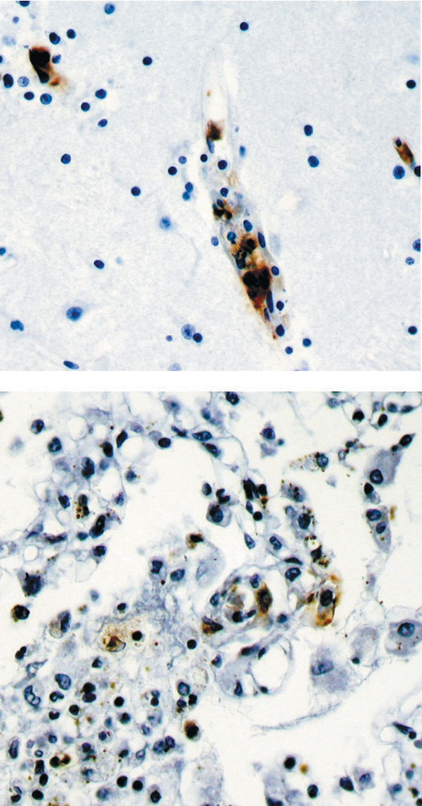 Immunohistochemical stain shows spotted fever group rickettsia in endothelial cells of a blood vessel in brain (top panel) and lung (bottom panel).