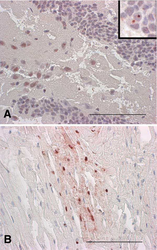 A) Distribution of Borna disease virus (BDV) p24 antigen in the hippocampus of shrew 144. Note the so-called Joest-Degen intranuclear inclusion bodies in multiple neurons in the gyrus dentatus; in some neurons, a homogenous intracytoplasmic staining can be seen (immunohistochemistry, ChemMate method [DAKO, Cygomation, Zug, Switzerland], ×40 [bar, 100 μm]). Inset: Joest-Degen intranuclear inclusion bodies are visible in multiple neurons in the gyrus dentatus (ChemMate method, ×100). B) Focal dist