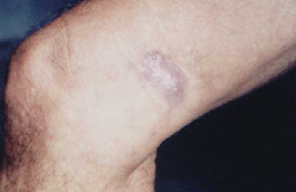 Erythematous-infiltrated, hypertrophic plaque with a verrucous surface ≈4 cm long in the distal third of the medical aspect of the right thigh of the patient.