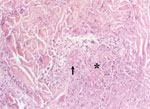 Thumbnail of Coagulative necrosis (*) of the dermis surrounding necrotic vessels (arrow) (hematoxylin-eosin-saffron; original magnification ×250).