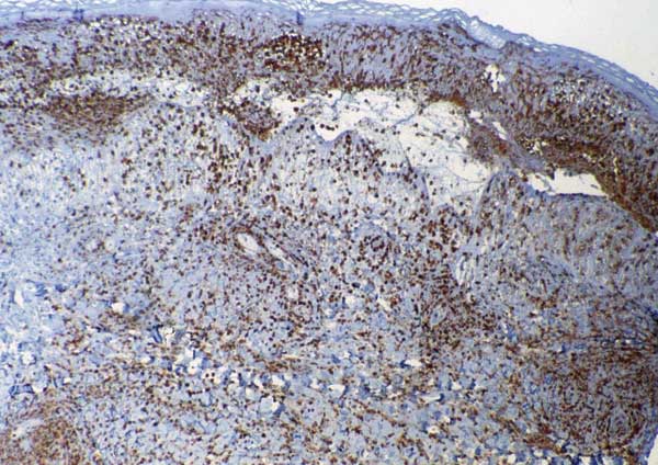 Inoculation eschar from a patient with African tick-bite fever showing numerous dermal inflammatory infiltrates mainly composed of polymorphonuclear leukocytes (immunoperoxidase staining with an anti-CD15 antibody; original magnification ×100).