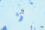 Thumbnail of Oocysts (arrows), stained by using the Ziehl-Neelsen method, in sputum from the patient with HIV.