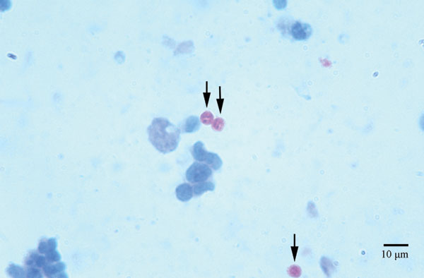 Oocysts (arrows), stained by using the Ziehl-Neelsen method, in sputum from the patient with HIV.