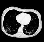Thumbnail of Computed tomography scan showing reticulonodular infiltrations of both lungs in the lower zones.