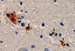 Thumbnail of Immunohistochemical analysis shows the presence of spotted fever group rickettsiae (brown) in vessels of brain of a patient with fatal Rocky Mountain spotted fever (magnification ×400).