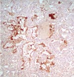 Thumbnail of Immunohistochemical staining of viral antigen in alveolar epithelial cells of patient A infected with avian influenza A (H5N1) virus (magnification ×100).