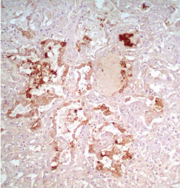 Immunohistochemical staining of viral antigen in alveolar epithelial cells of patient A infected with avian influenza A (H5N1) virus (magnification ×100).