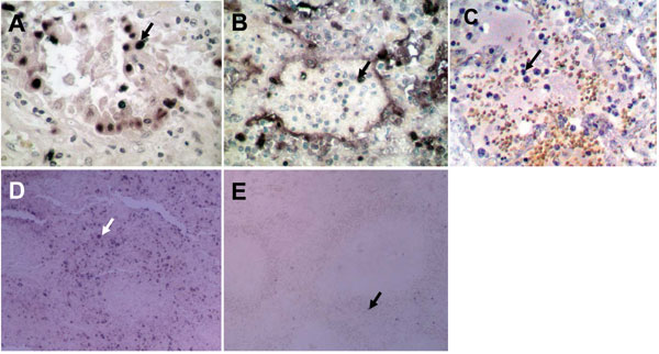 Terminal deoxynucleotidyl transferase–mediated dUTP-biotin nick end-labeling staining showing numerous apoptotic alveolar epithelial cells in lung of patient B (A) and leukocytes in lung of patient A (B). C) Lung tissue from a patient with pneumonia caused by human influenza A (H5N1) virus showing apoptosis only in leukocytes. D) Spleen of patient B showing numerous apoptotic cells. E) Normal spleen tissue showing only a minimal level of apoptosis. Apoptotic cells are stained dark blue and an apoptotic cell in each panel is indicated by an arrow. Magnification ×400 in A, B, and C; ×100 in D and E.