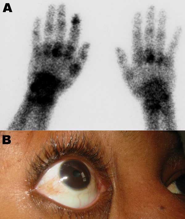 Clinical findings in patients. A) Bone scintigraphy of the wrists and hands showing an intense focus of technetium-99m–labeled methylene diphosphonate tracer uptake, particularly on the left side in the left metacarpophalangeal, wrist, and the first distal interphalangeal joints in a 73-year-old man who returned from Reunion with a severe viremic chikungunya virus (CHIKV) infection. B) Conjunctivitis in a 31-year-old woman who returned from Mayotte, French Comoros, with a severe viremic CHIKV in