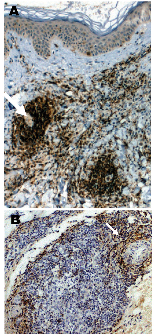 A case of lymphocytoma. A) Immunohistochemical image with anti-CD20 antibody showing a nodule with a dense B-lymphocytes infiltrate in the dermis; magnification ×100. B) Immunohistochemical image with anti-CD45 Ro antibody showing T-lymphocytes at the periphery of a nodule; magnification ×250.