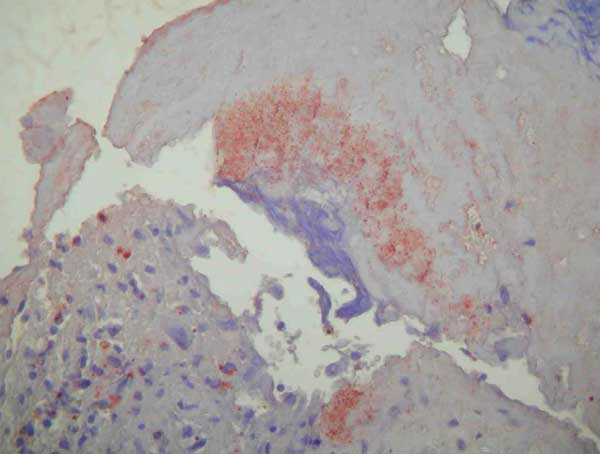 Immunohistochemical demonstration of bartonellae in the mitral valve with peroxidase-conjugated polyclonal rabbit anti–Bartonella sp. antibodies. The organisms stain dark orange against the hematoxylin counterstain; original magnification ×200.