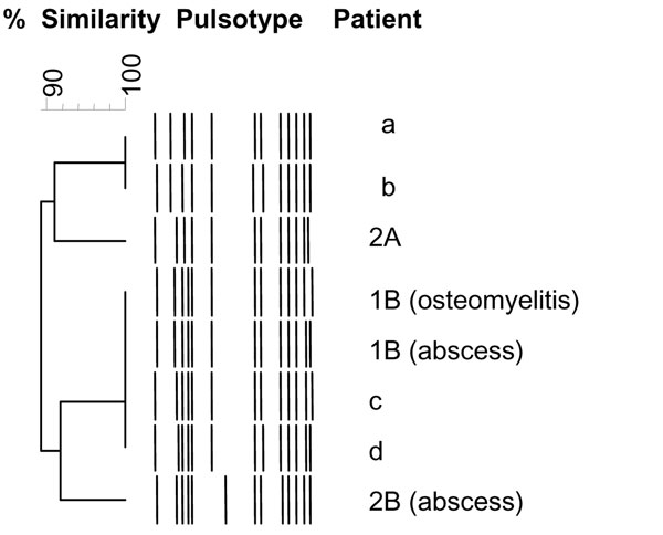 Dendogram constructed from the schematic representation of the pulsed-field gel electrophoresis types of 4 epidemic methicillin-susceptible Staphylococcus aureus (MSSA) isolates included in this study (patients 2A, 1B, and 2B); 1 strain subsequently isolated from an abscess in a soldier belonging to company A, who had been in Côte d’Ivoire in October 2005 (patient b); and 3 MSSA strains isolated from abscesses in soldiers belonging to a company other than A or B (patients a, c, d). Isolates from