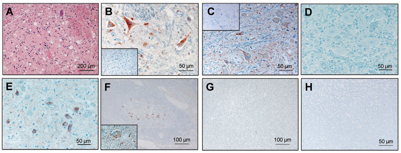 Histopathologic and immunohistochemical analyses. A) Spongiform lesions; B) partially proteinase K–resistant prion protein (PrPsc) deposits detected by immunohistochemistry (monoclonal antibodies [MAb] F99/97.6.1 diluted 1:500) in the nucleus of the solitary tract (STN) in the zebu under investigation. C–E) Comparative immunohistochemistry with MAb P4 (1:800) in the olivary nuclei of the zebu (C), a bovine spongiform encephalopathy (BSE)-positive cow (D), and a scrapie-positive sheep (E). Insets