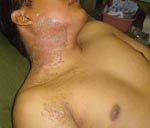 Thumbnail of El Salvadorian infantry soldier (commando) with the characteristic rash seen after an encounter with the “pissing beetle” while sleeping.