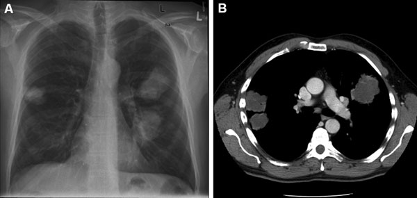 A) Chest radiograph and B) computed tomography scan of the patient showing 3 nodular Cryptococcus gattii infiltrates near pleura.