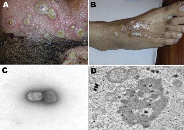 Nosocomial buffalopoxvirus infection of patients in burns units. A) Lesions involving intact skin around a burn wound and the wound itself. B) Lesions around an insertion site for an intravenous line. C) Orthopoxvirus particles detected by electron microscopy (EM) examination of negatively stained grids prepared from pustular material (magnification ×73,000). D) Transmission EM examination of ultrathin sections of infected Vero cell cultures showing classic intracytoplasmic orthopoxvirus factories and maturing virus particles (magnification ×21,000).