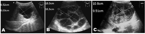 Ultrasonographic images of cystic echinococcosis in the liver in patients from the Yanahuanca district, Central Peruvian Highlands. A) Cyst type CE1; B) Cyst type CE2; C) Cyst type CE4.