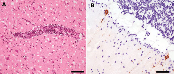 A) Moderate perivascular inflammatory infiltrates and slight diffuse infiltration of brain parenchyma by mononuclear cells in basal ganglia (hematoxylin and eosin stain, bar = 110 μm). B) Immunohistochemical findings for tickborne encephalitis virus (TBEV): strong immunolabeling of cerebellar Purkinje cell perikaryon and apical dendrites (anti-TBEV, bar = 60 μm).