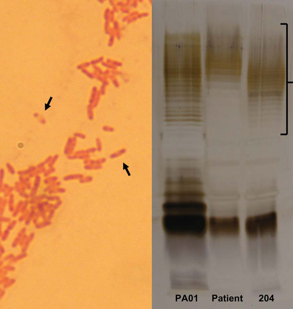 A) Gram stain of pus from the patient’s submental collection, showing the characteristic safety-pin pattern (arrows) of bipolar staining. B) Sodium dodecyl sulfate–polyacrylamide gel electrophoresis of lipopolysaccharide (LPS) antigens from the patient and Burkholderia pseudomallei reference strain (204), showing different O-repeating units (bracket). A control isolate of Pseudomonas aeruginosa LPS (PA01) is shown for comparison.