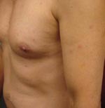 Thumbnail of Multiple papules on torso, upper arms, and legs.