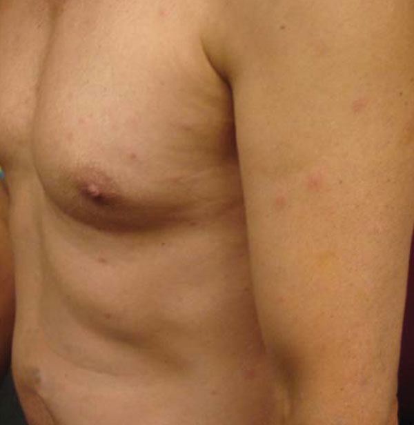Multiple papules on torso, upper arms, and legs.