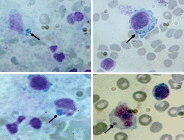 Peripheral blood smears (buffy-coat preparation) showing variable-sized basophilic inclusions (arrows) in mononuclear cells from a 9-year-old boy with human monocytic ehrlichiosis, Carabobo, Venezuela. Dip Quick (Jorgensen Laboratories, Inc., Loveland, CO, USA) staining; magnification ×1,000.