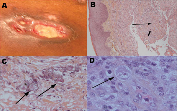 A) Ulcerated, violaceous plaque on the trunk of the patient with undermined infiltrated peripheral walls. B) Section of the lesion in A showing diffuse dermal-hypodermal necrosis with neutrophil infiltration (thin arrow) and sparse histiocytelike cells (thick arrow) (hematoxylin and eosin–stained, magnification ×10). C) Surgical skin biopsy specimen showing amebic cysts (arrows) in the dermal-hypodermal junction (hematoxylin and eosin–stained, magnification ×20). D) Surgical skin biopsy specimen showing intravascular amebic trophozoite (arrow) characterized by acanthopodia, cytoplasmic vacuoles, and a prominent nucleolus (hematoxylin and eosin–stained, magnification ×40).
