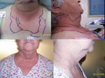 Thumbnail of Top, anterior and lateral views of patient on day 1 of receiving antimicrobial drugs, demonstrating neck erythema and edema. Bottom, anterior and lateral views of patient on day 8 of receiving antimicrobial drugs, demonstrating resolution of neck erythema and edema.
