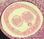 Thumbnail of Transverse section of a female worm and surrounding tissue isolated from the patient (hematoxylin and eosin stained). Scale bar = 100 μm.