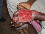 Thumbnail of A typical Buruli ulcer in a 17-year-old boy identified during the assessment.