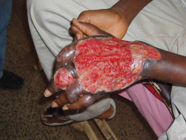 A typical Buruli ulcer in a 17-year-old boy identified during the assessment.