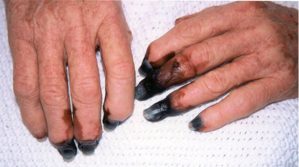 Digital gangrene in a patient (case 2) with Rickettsia australis infection.