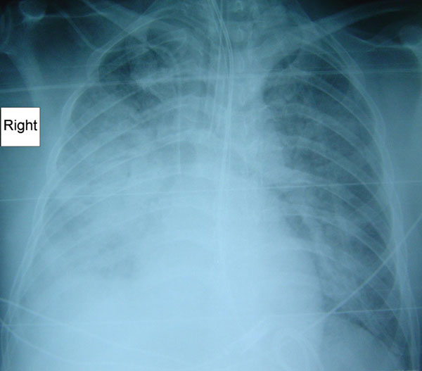 Radiograph showing pneumonia in a patient (case 3) with Rickettsia australis infection.